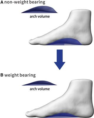 A cross-sectional study of medial longitudinal arch development in children with different BMI